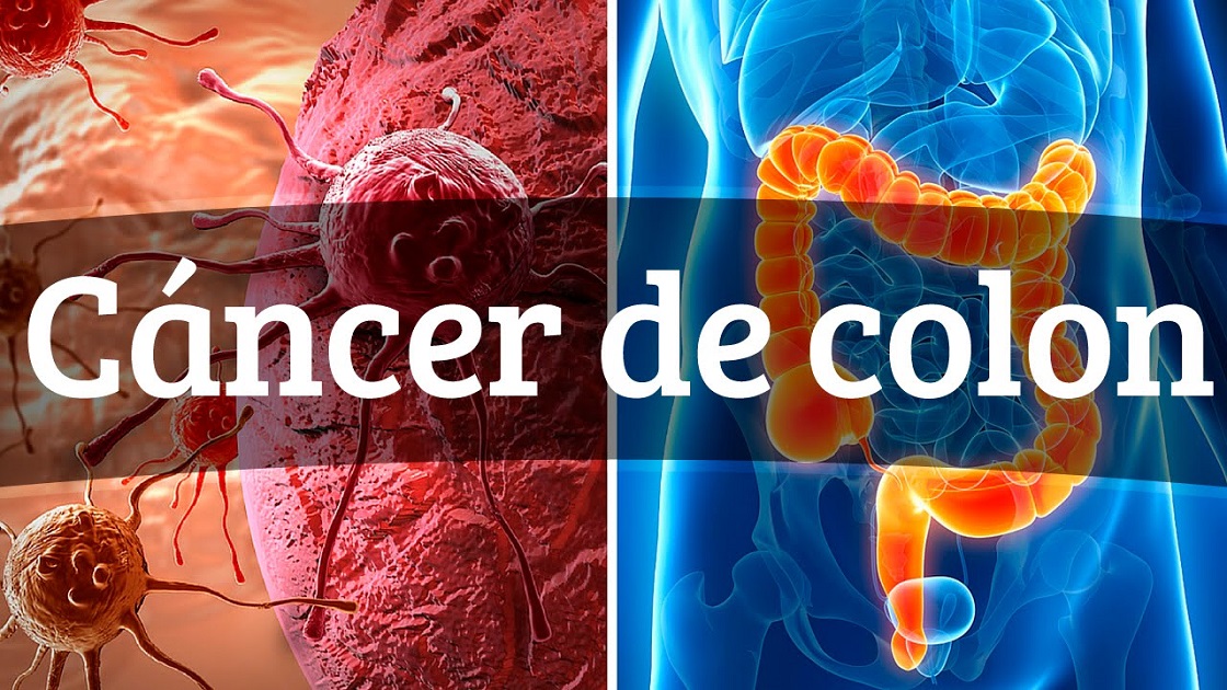 Día de la prevención del cáncer de colon (31 de Marzo)